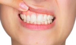Diş Eti Kaşıntısı Neden Olur? Uzmanlardan Uyarı Basit Bir Belirti Olmayabilir