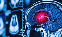 Menenjiom Nedir? Beyin Zarlarından Kaynaklanan Sessiz Tehlike