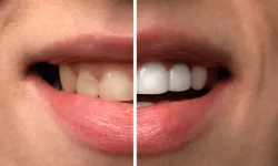 Masum gibi görünen 8 yiyecek dişleri sinsi sinsi çürütüyormuş